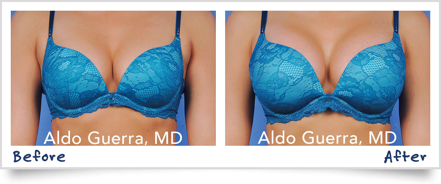 Actual breast augmentation patient before and after photo