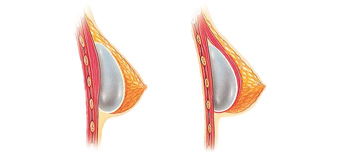 Breast implant placement diagrams for over and under the muscle