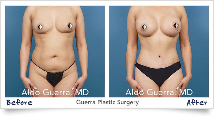 Before and After photo of actual patient YA