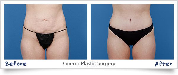 Tummy Tuck before and after photo