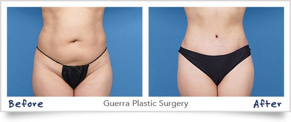 Tummy Tuck Before and After photo of actual patient