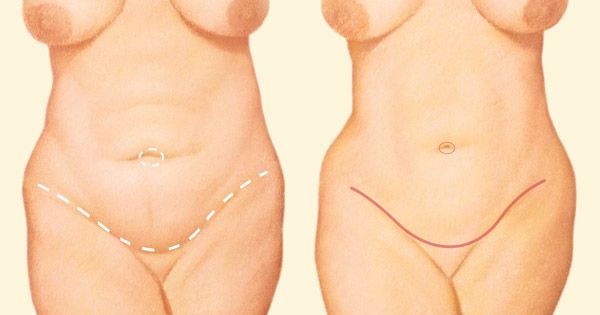 Tummy Tuck incision diagram