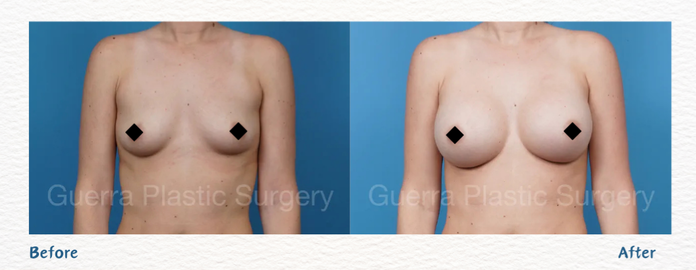 Breast Augmentation before and after Case 31496