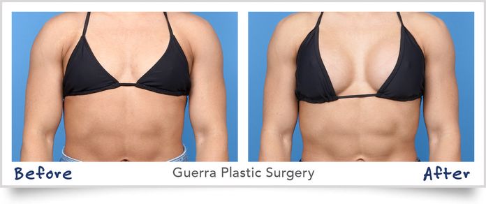 Actual Patient - Before and After photo #38801 - Dr. Ogley