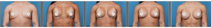 Pictures of implants before and after dropping