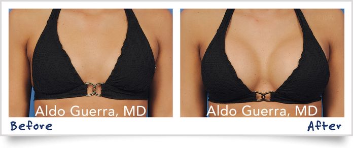 Before and After photo of actual patient - Breast Augmentation - Dr. Guerra