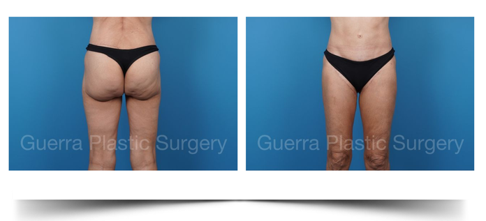 after modified spiral thigh lift back and front