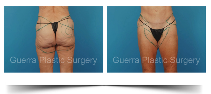 green surgical markings