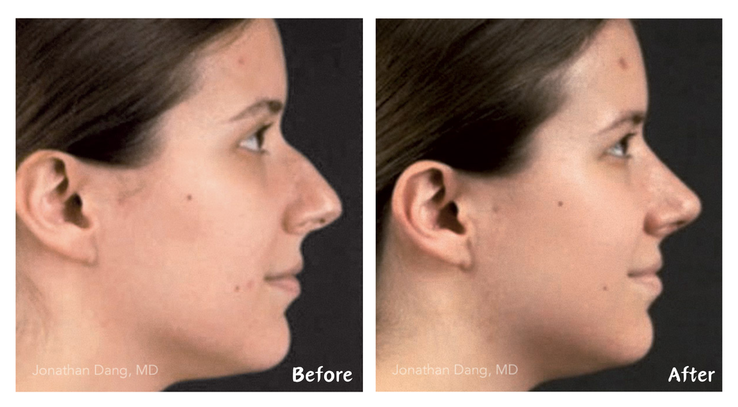 Rhinoplasty Phoenix Scottsdale A Deeply Individualized Procedure