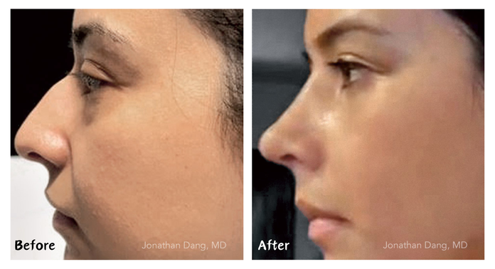 Asian Rhinoplasty before and after photos, actual patient.