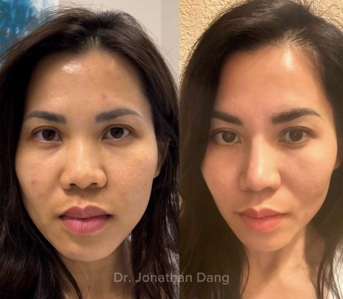 ethnic rhinoplasty before and after photos, actual patient.