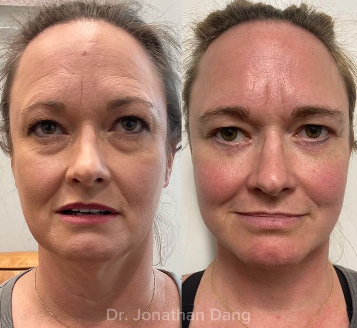 facelift before and after photos, actual patient.