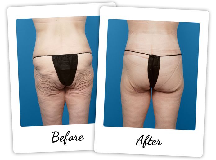 Modified Spiral Thigh Lift - Actual Patient Before and After