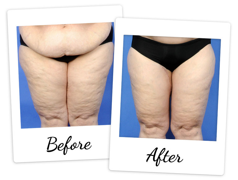 Before and after photo of actual patient - Thigh Lift