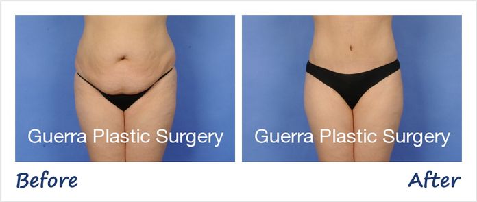 Actual tummy tuck patient before and after photo