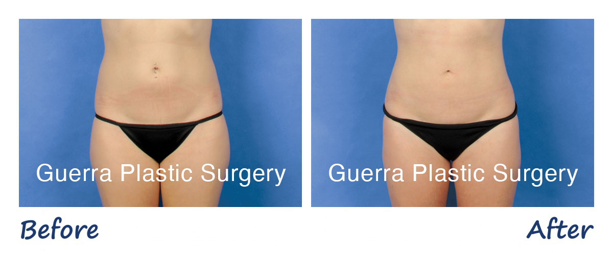 Liposuction photos