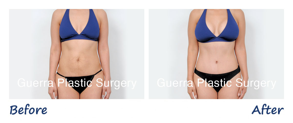 Mommy Makeover + Breast Augmentation photos