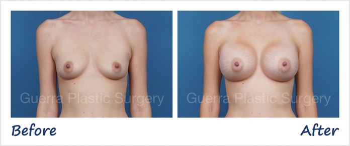 Actual breast augmentation patient before and after photo