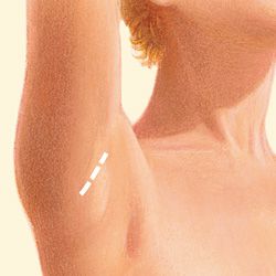 Armpit incision diagram