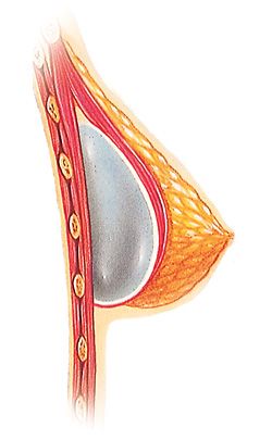 Diagram of implant under the muscle