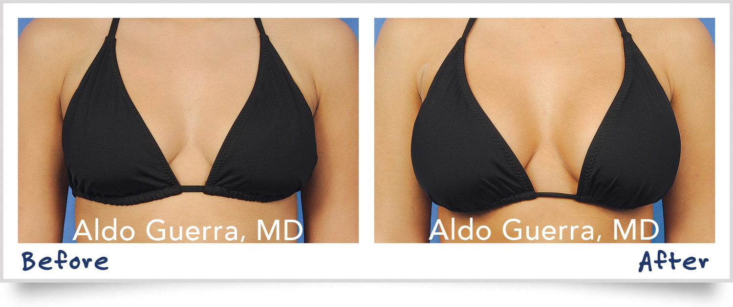 Actual breast lift patient before and after photo