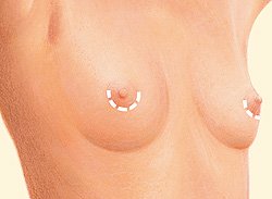 Nipple incision diagram