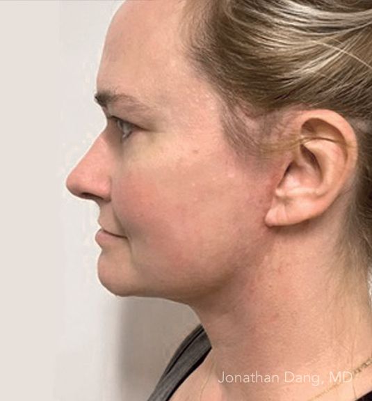Patient after facelift - photo courtesy of Dr. Dang