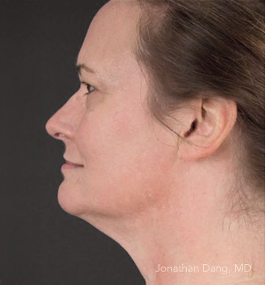 Patient before facelift - photo courtesy of Dr. Dang