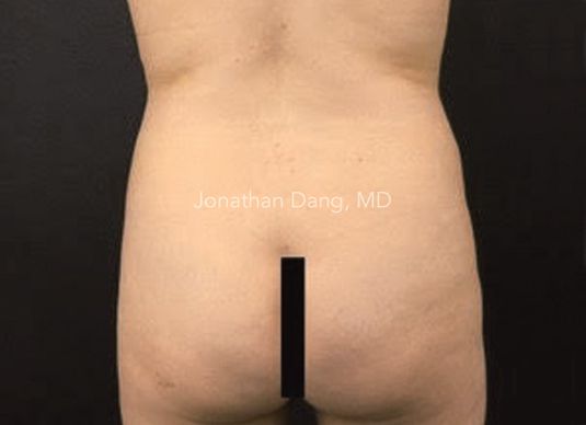 Patient before liposuction and brazilian butt lift - photo courtesy of Dr. Dang