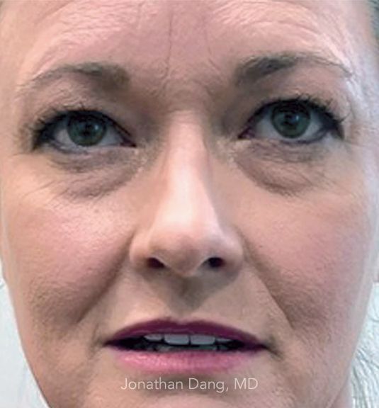Patient before lower eyelid surgery - photo courtesy of Dr. Dang