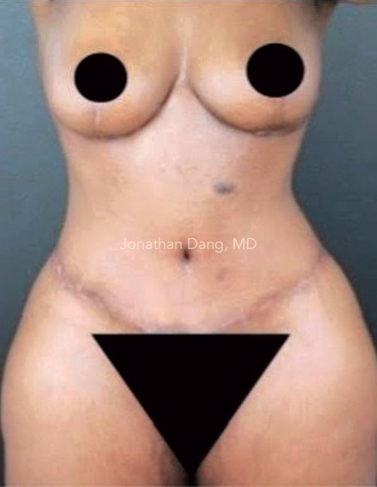 Patient after tummy tuck and brazilian butt lift - photo courtesy of Dr. Dang
