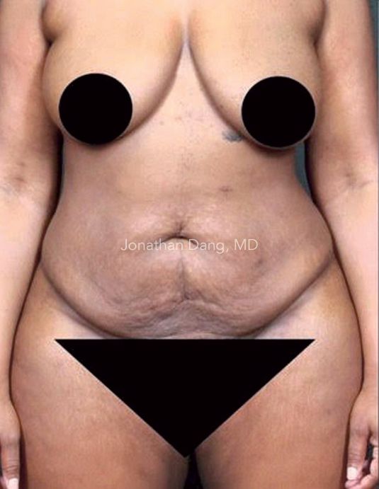Patient before liposuction and brazilian butt lift - photo courtesy of Dr. Dang
