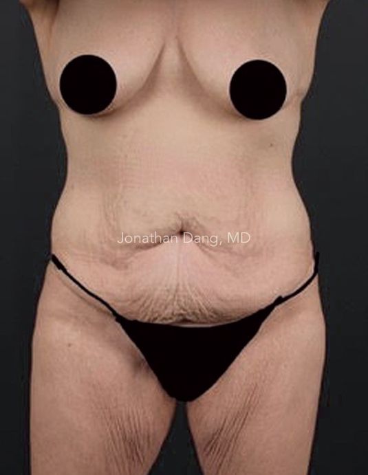 Patient before liposuction and brazilian butt lift - photo courtesy of Dr. Dang