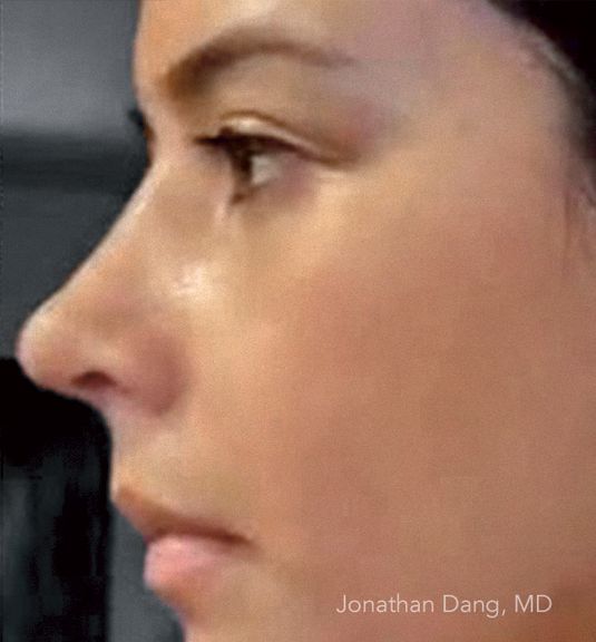 Patient after rhinoplasty - photo courtesy of Dr. Dang