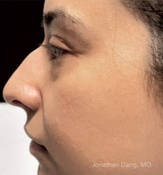 Patient before rhinoplasty - photo courtesy of Dr. Dang