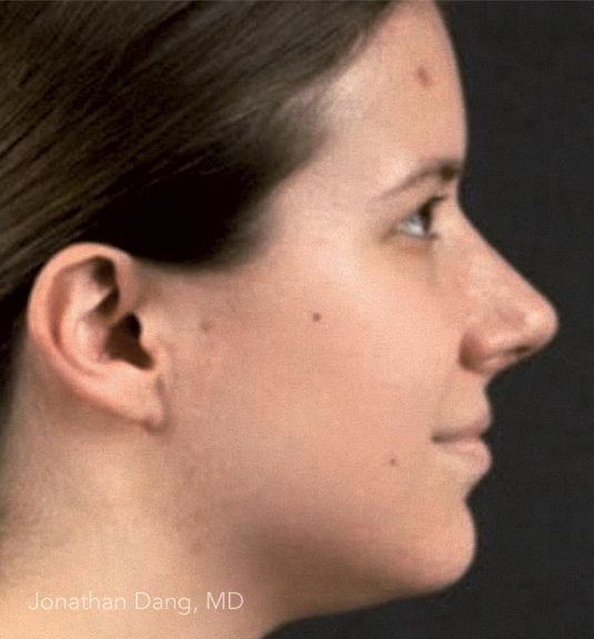 Patient after rhinoplasty - photo courtesy of Dr. Dang