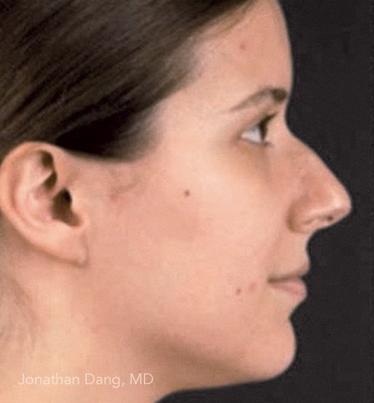 Patient before rhinoplasty - photo courtesy of Dr. Dang