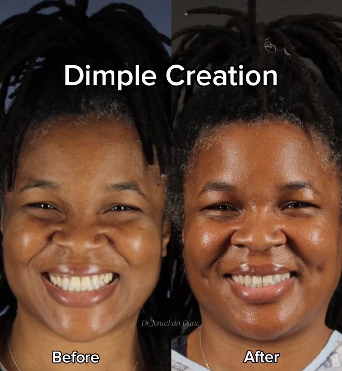 Dimpleplasty 1