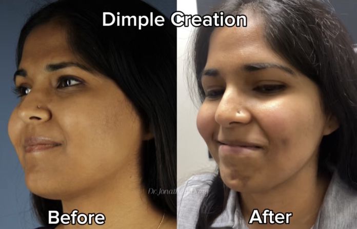 Dimpleplasty 2