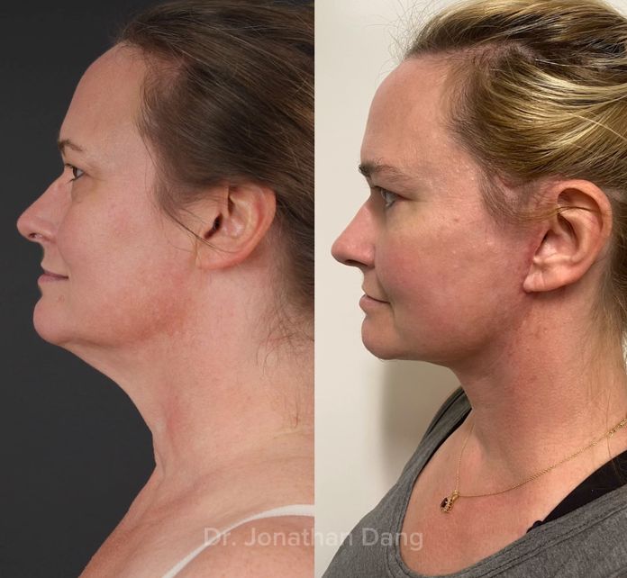 Facelift 2
