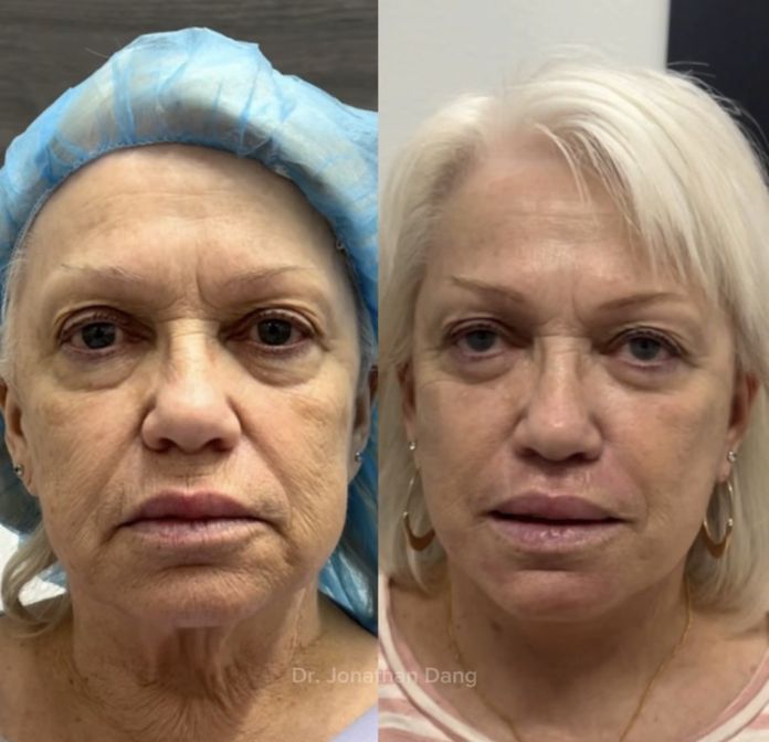Facelift 3
