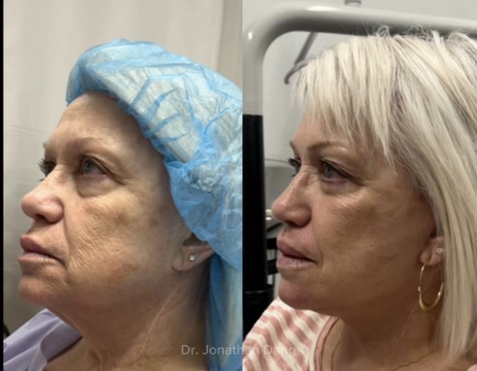 Facelift 4
