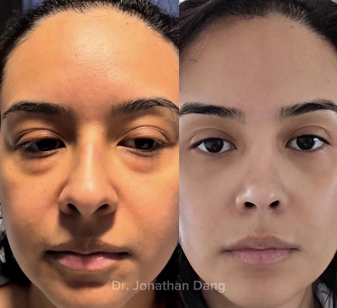 Lower Blepharoplasty 1