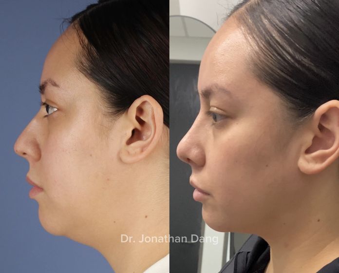 Neck Liposuction 2