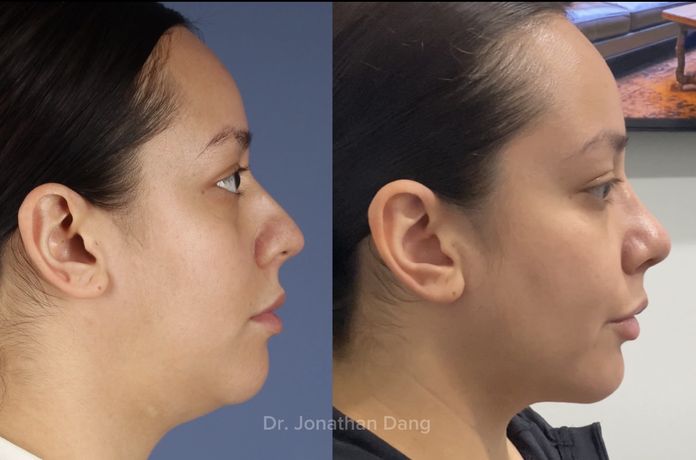 Rhinoplasty 10