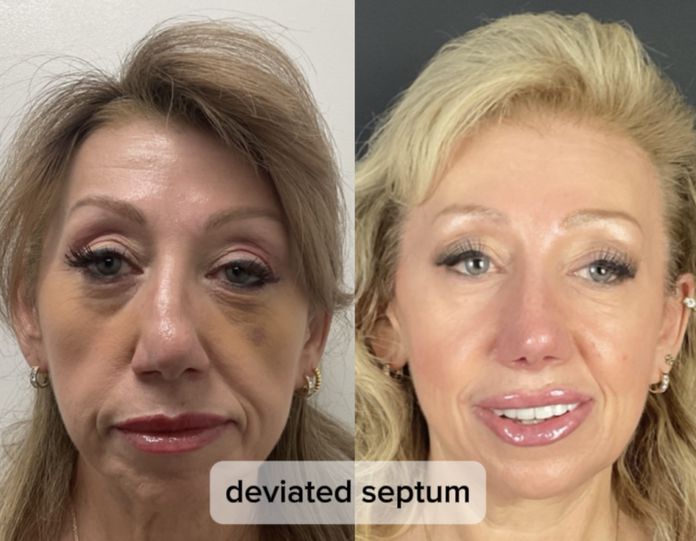 Rhinoplasty 11