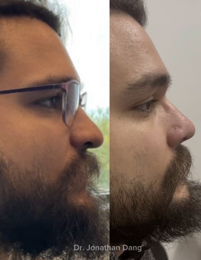 Rhinoplasty 13