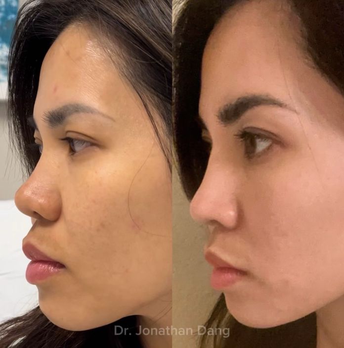 Rhinoplasty 2