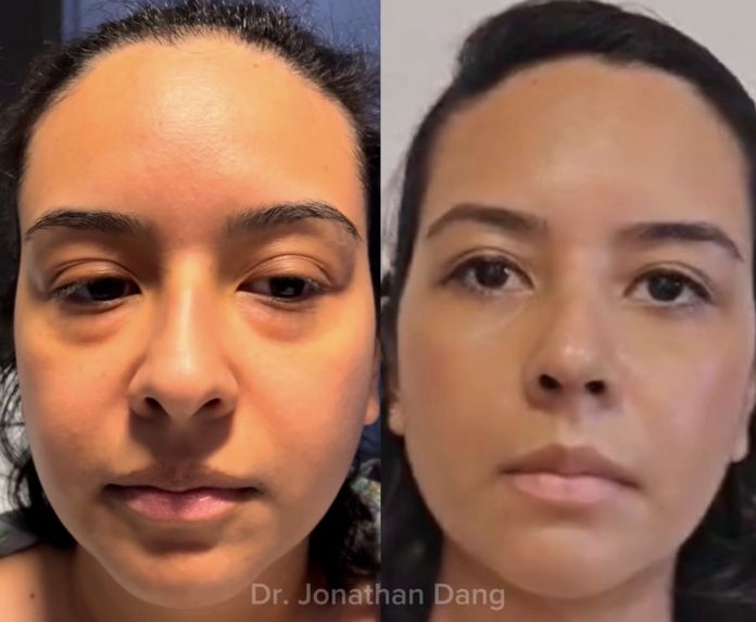 Rhinoplasty 3