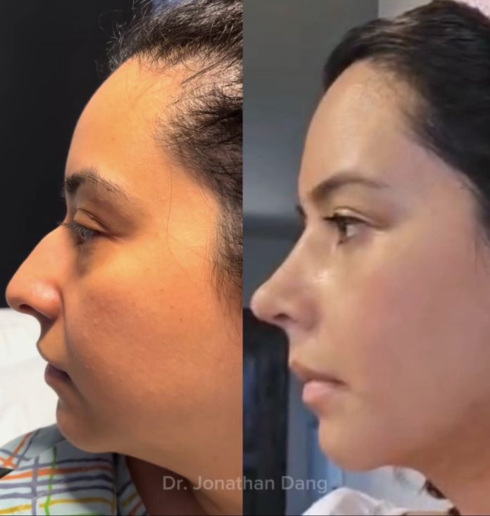 Rhinoplasty 4